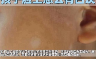 儿童脸上白色糠疹图片是哪种皮肤病？需要治疗吗？