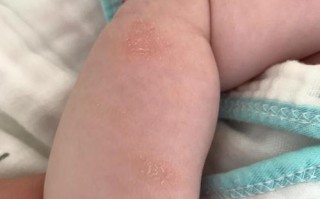 新生儿脱皮是正常现象吗？