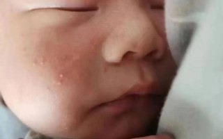 新生儿脸上有小红点点