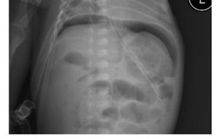 新生儿肠穿孔的存活比例究竟有多高？哪些因素会影响他们的生存几率？