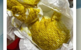 新生儿黄疸大便是什么颜色