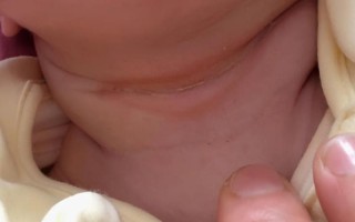 新生儿脖子褶皱处破皮