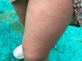 儿童过敏性皮炎症状图片有哪些表现？