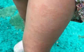 儿童过敏性皮炎症状图片有哪些表现？