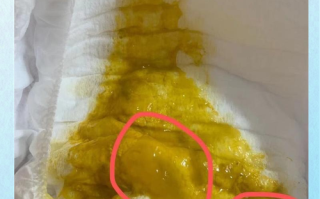 新生儿大便呈果冻状正常吗？附图片详解不同情况下的应对方法
