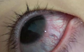 新生儿眼睛出现一条红血丝是正常现象还是疾病信号？需警惕哪些潜在原因？