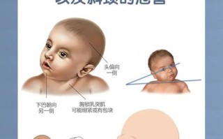 新生儿先天性斜颈能治好吗？