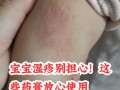 地奈德乳膏儿童使用安全吗？适用年龄与剂量该如何把控？