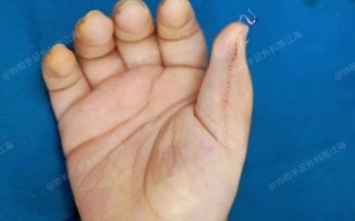 新生儿六指畸形究竟是如何形成的？背后隐藏着哪些遗传与环境因素？