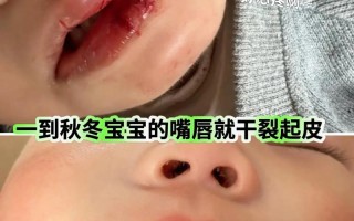 新生儿嘴唇干裂脱皮怎么办？