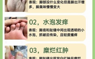 孕期脚气怎么办？用药安全吗？