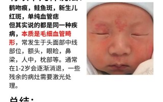 新生儿血管瘤最佳治疗时间