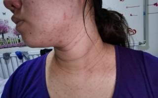 孕期脸上长粉刺严重，该怎么办才能安全又有效呢？
