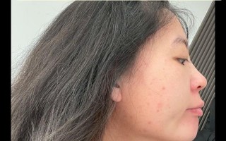 怀孕期间长痘痘怎么办？安全有效的祛痘方法有哪些？