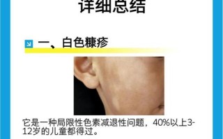 儿童单纯糠疹怎么治疗