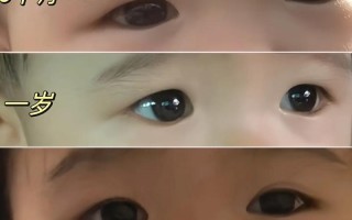 新生儿双眼皮能确定吗？