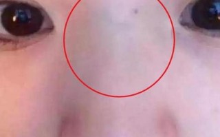 新生儿鼻子中间有条线是正常现象吗？会影响颜值或健康吗？