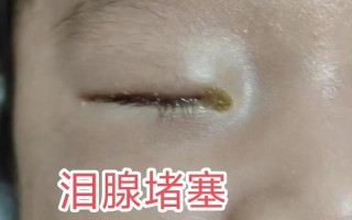 新生儿先天性泪道阻塞不流泪就没事吗？需要治疗吗？