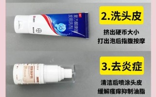 新生儿长头皮屑怎么办