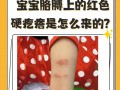新生儿脸上红色疙瘩是湿疹还是痤疮？该如何正确护理？