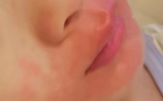 儿童烟雾病早期症状有哪些容易被忽视的信号？家长该如何识别？