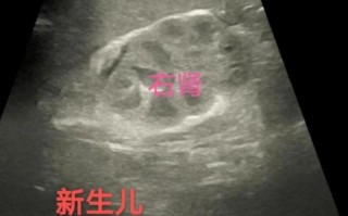 新生儿肾上腺皮质增生有哪些典型症状？