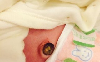 新生儿第九天脐带出血是正常现象还是异常情况？需要如何正确处理？