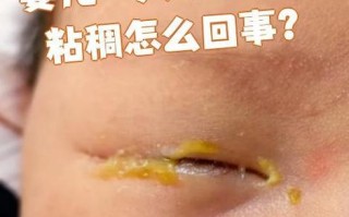 新生儿黄眼屎是上火还是生病了？