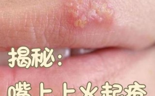 孕期上火嘴角溃烂怎么办？能用药吗？如何快速缓解又不影响胎儿？
