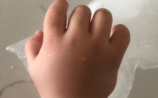 儿童手指关节肿大图片，是正常发育还是疾病的警示信号？