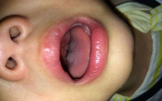 新生儿嗓子里感觉有痰，是正常现象还是生病了？需要家长注意什么？