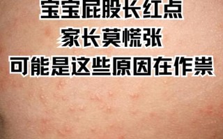 新生儿屁股上长尿布疹，到底该如何科学护理才能快速缓解？