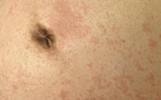 孕期血糖高是否真的会导致宝宝长湿疹？这两者之间到底存在什么关联？