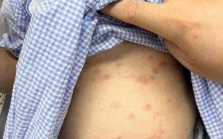 新生儿感染巨细胞病毒后会有哪些典型症状？家长该如何早期识别和应对？