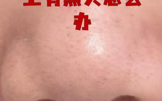 儿童鼻子长黑头怎么办？日常清洁与护理的正确方法是什么？