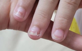 手足口病后儿童指甲脱落是正常恢复现象还是异常信号？