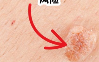 怀孕期间感染尖锐湿疣的原因和应对措施是什么？