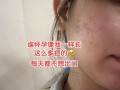 孕期长粉刺怎么办？