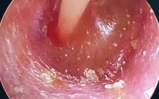 孕期得了分泌性中耳炎，会对胎儿有影响吗？该怎么治疗才安全？