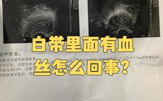 孕期白带出现血丝是危险信号吗？需要立即就医吗？