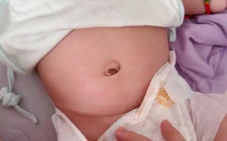 新生儿肚脐凸起是正常现象还是异常信号？家长该如何正确护理与应对？