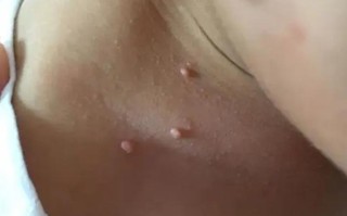 新生儿胸前长的小肉粒是什么？需要治疗吗？会自己消失吗？