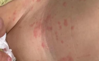 儿童出风疹的症状图片有哪些典型表现？如何通过图片识别与普通皮疹的区别？