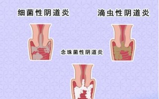 怀孕期间细菌性阴道炎会影响胎儿健康吗？该如何安全治疗？