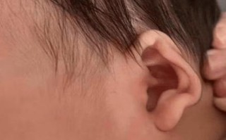 新生儿左耳没有外耳廓