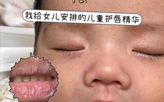 新生儿嘴唇脱皮是何原因？