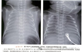 新生儿肺透明膜病的X线影像有哪些典型表现及诊断要点？