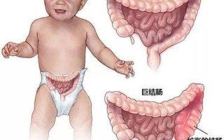 儿童肠结节有哪些典型症状？家长该如何早期识别与应对？