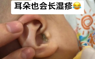 新生儿一只耳朵流黄水