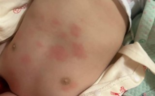 新生儿身上起红疹子带白尖是正常现象还是疾病信号？
